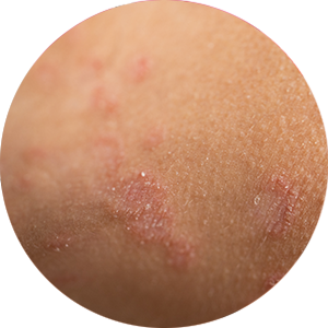 Psoriasis