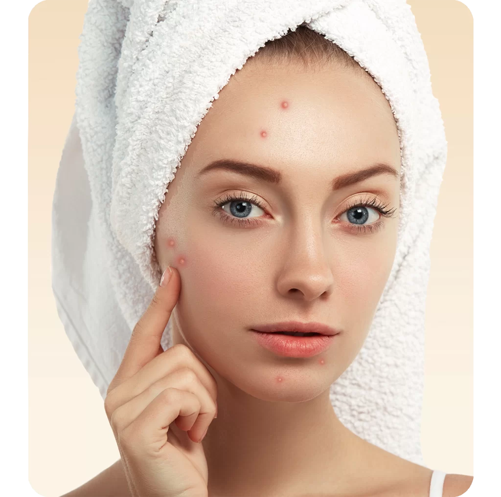 woman with acne